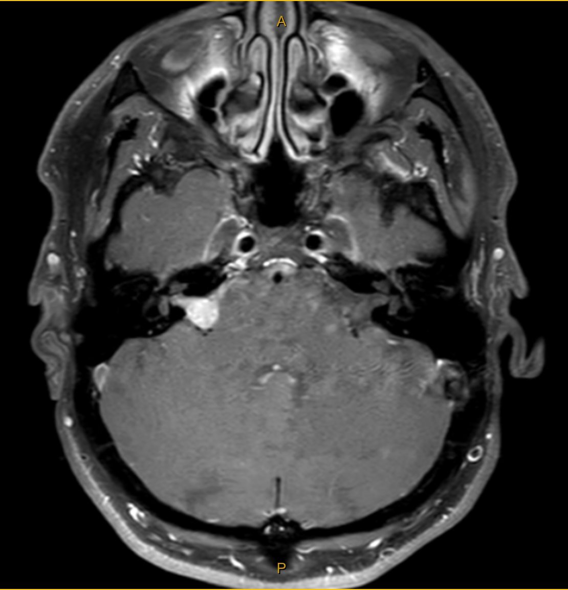 MRI scan, axial view
