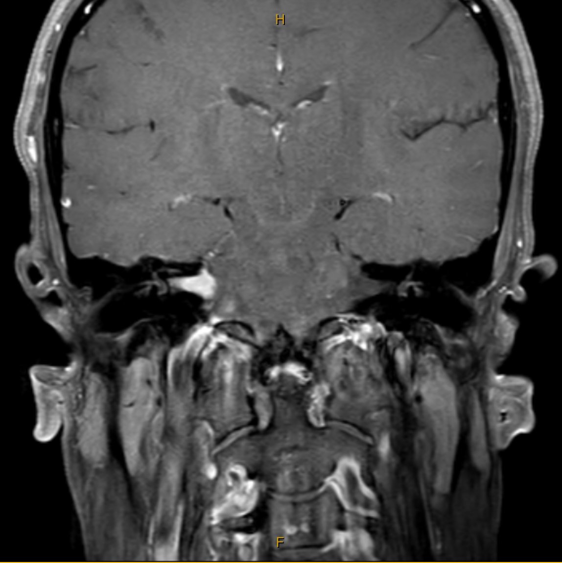 MRI scan, coronal view