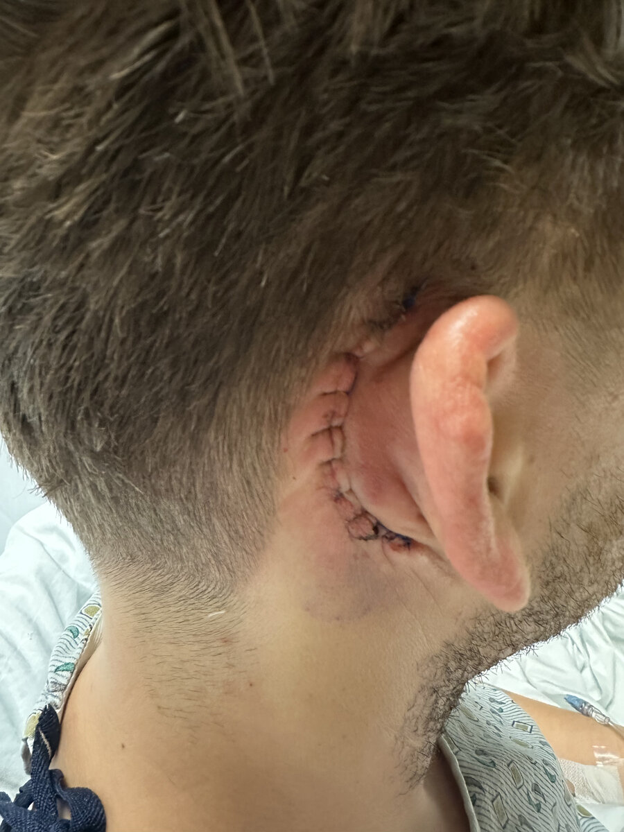 Post-surgical scar, healing